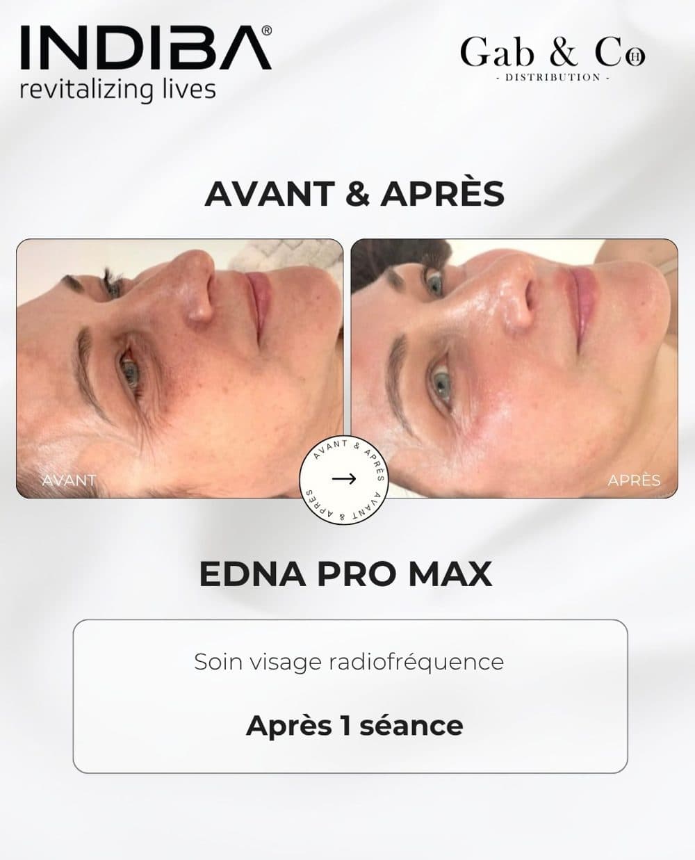 Avant / après soin visage radiofréquence INDIBA